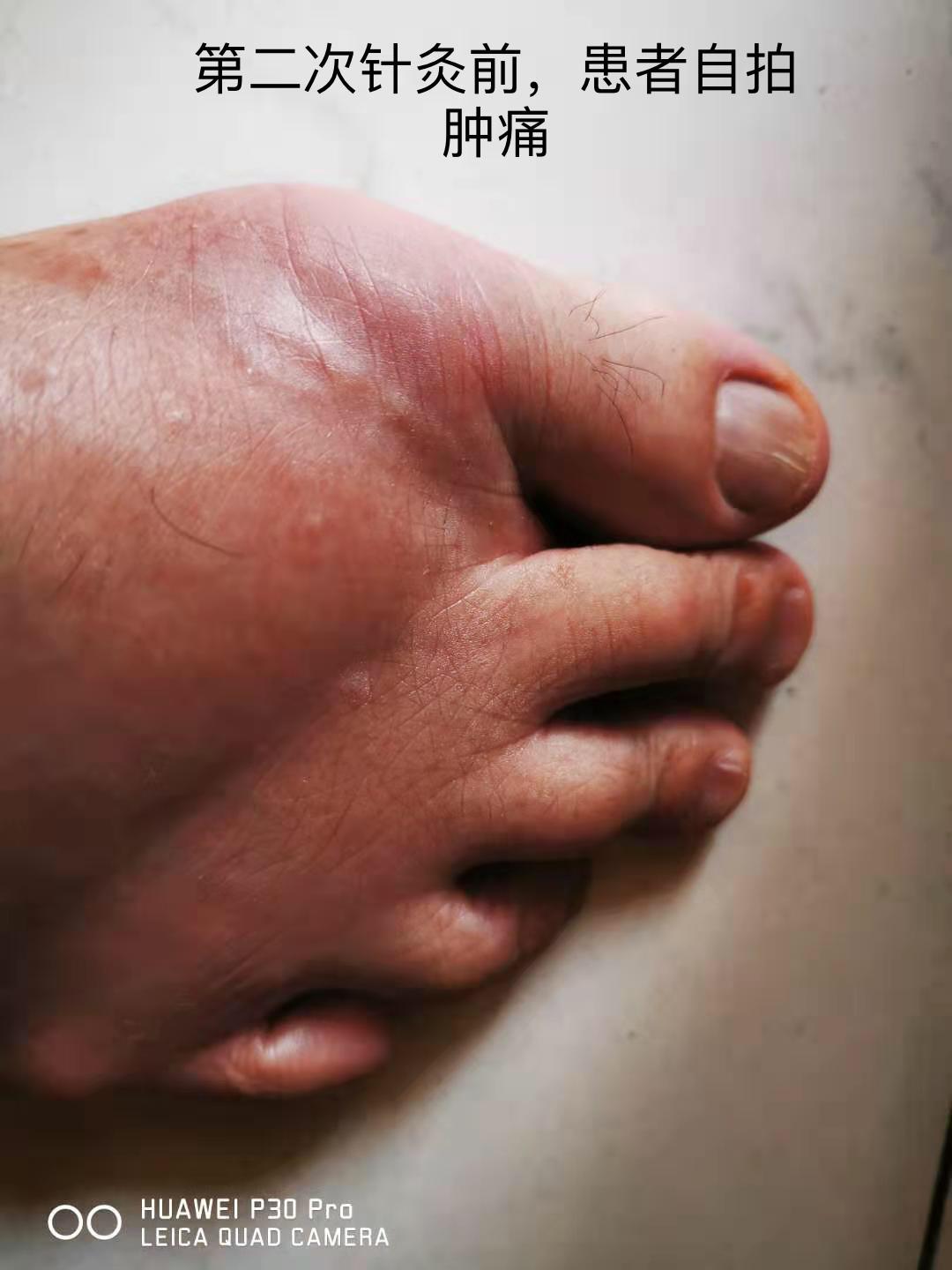 痛风急性发作的针灸方法和技巧 - 好大夫在线