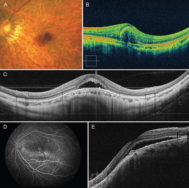 的鉴别诊断:a,b 漆样裂纹所致出血;c 为圆顶样黄斑伴浆液性视网膜脱离