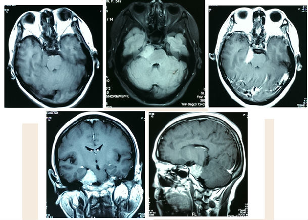 岩骨斜坡脑膜瘤的手术治疗 - 好大夫在线