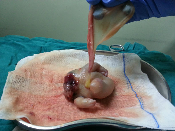 颅部寄生胎图片