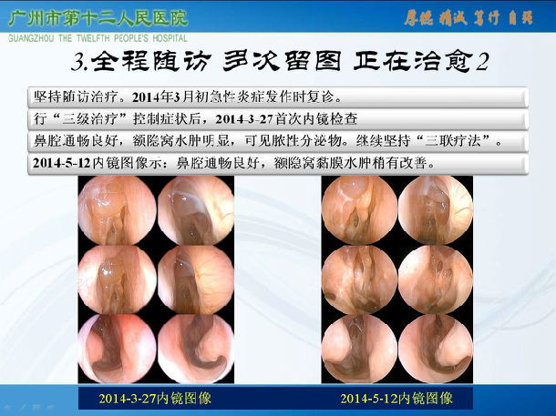 难治性鼻-鼻窦炎可治愈性临床观察_鼻息肉_饮食运动_营养与饮食 - 好