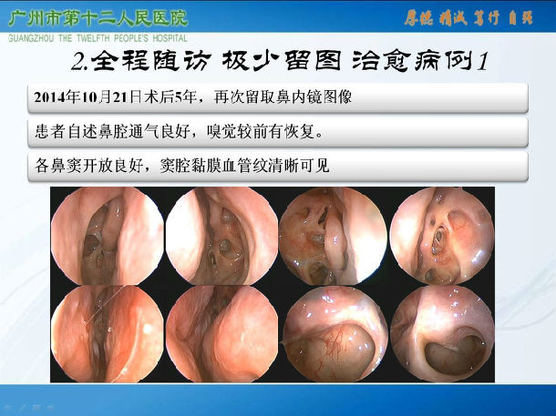 鼻窦炎白色分泌物图片图片