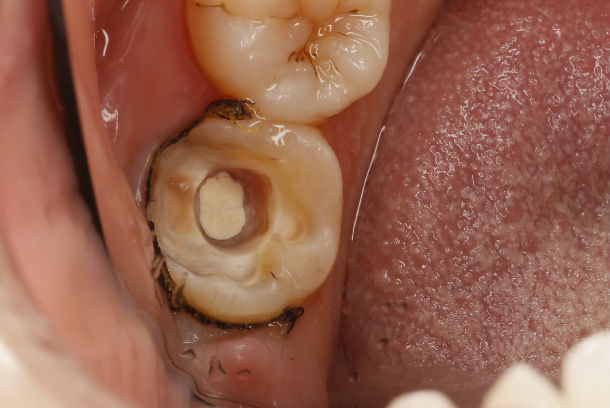 死髓牙嵌体图片