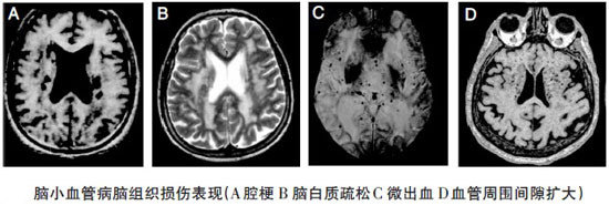 原发性血管炎(pacns)毛细血管前后的小动脉和小静脉周围的软脑膜浸润