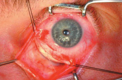 眼部海绵状血管瘤图片