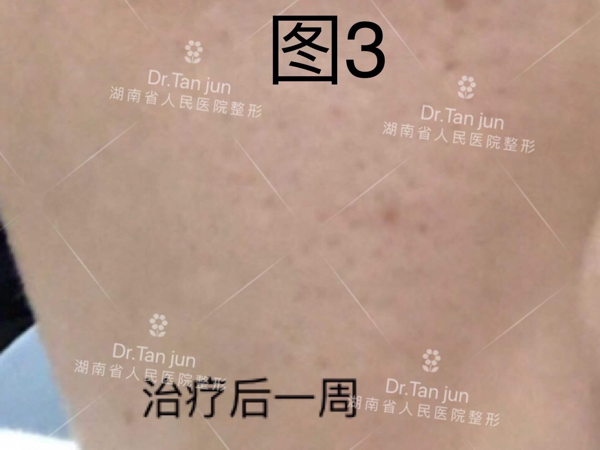 鸡皮肤打完激光后有红斑(鸡皮肤打完激光后有红斑正常吗)