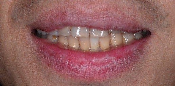 患者非常满意,没有痛苦,不损伤牙齿的固定修复方法你值得拥有!