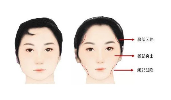 改变不了骨骼,那么造成"牙套脸"可能有三个方面的原因:咀嚼肌萎缩,增