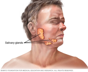 腮腺混合瘤症状图片图片
