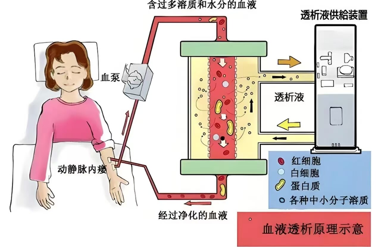 血液透析原理图.jpg
