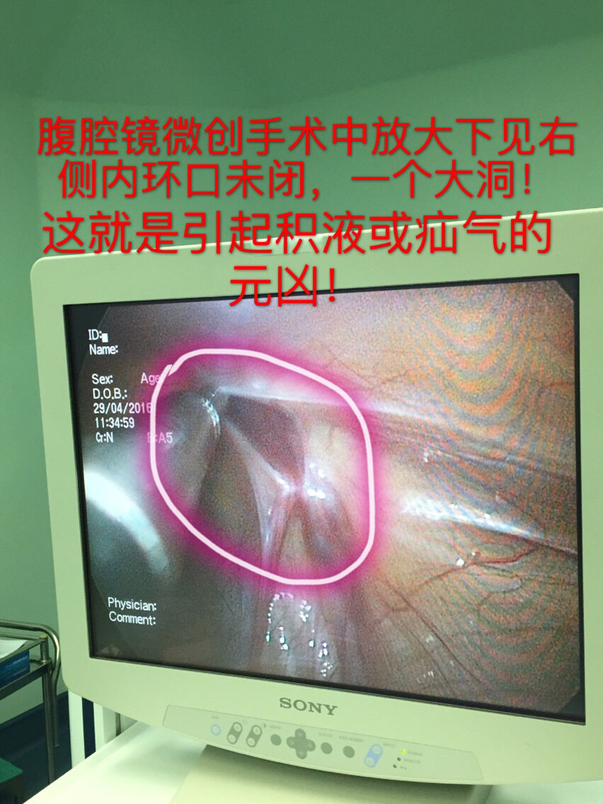 一分鐘看圖瞭解什麼是疝氣及腹腔鏡微創手術