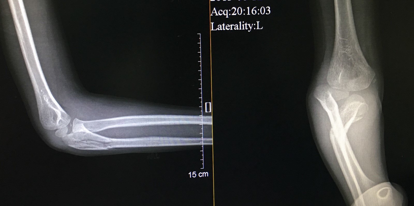 病例2 患者,男6歲,尺骨近端骨折並橈骨小頭脫位本文是黎潤光版權所有