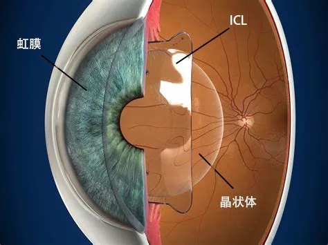 高端晶体手术和icl手术及激光手术漫谈 近视眼手术 近视眼手术手术