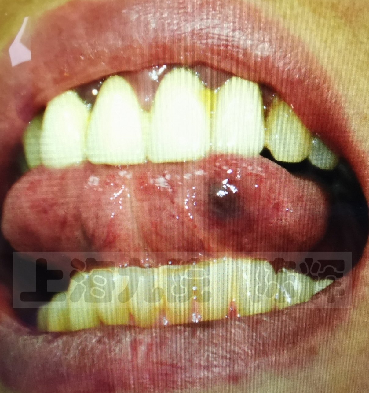 嘴巴里的黑血泡的图片图片