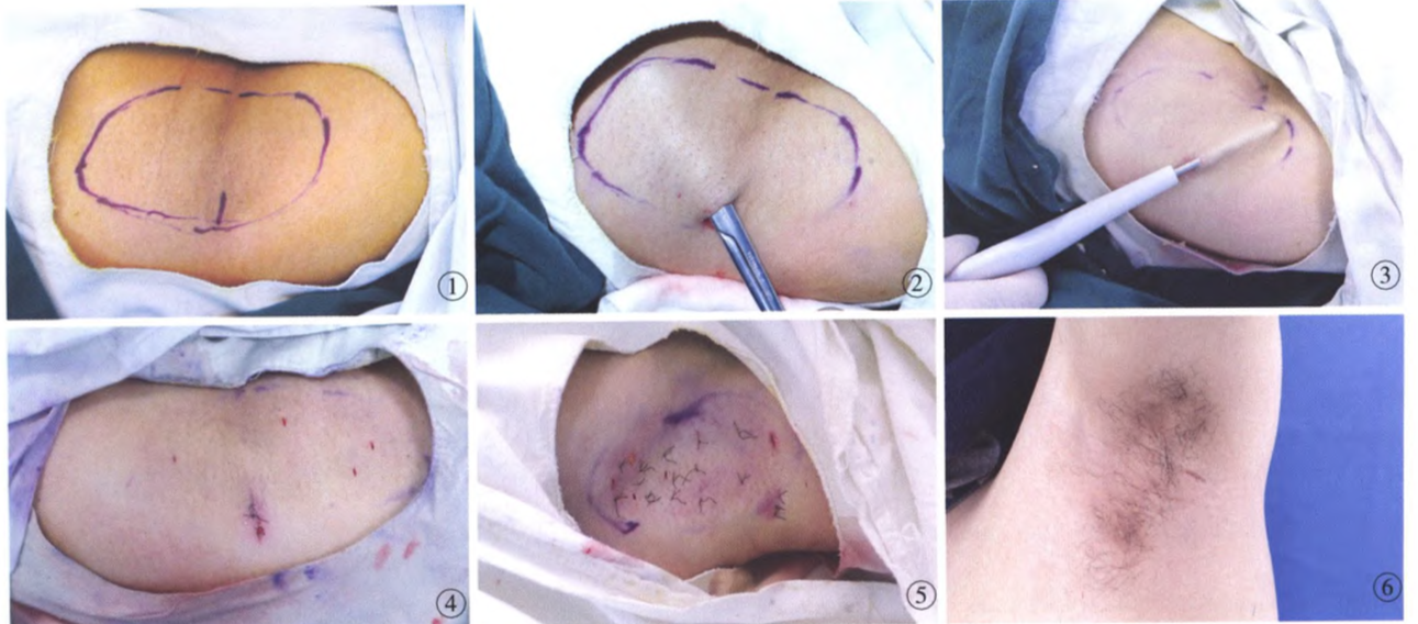 surgical treatment of axillary bromhidrosis by combining suction