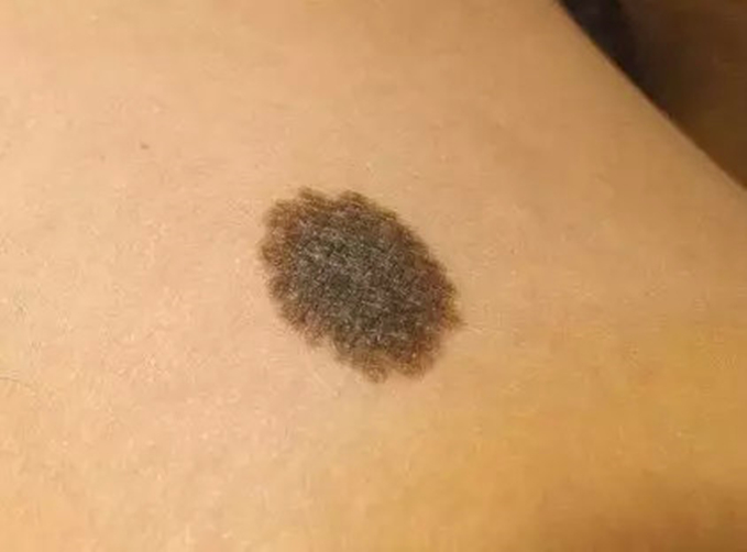 色素痣真的会演变成黑色素瘤吗?