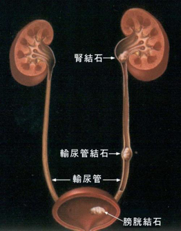输尿管中段结石图图片