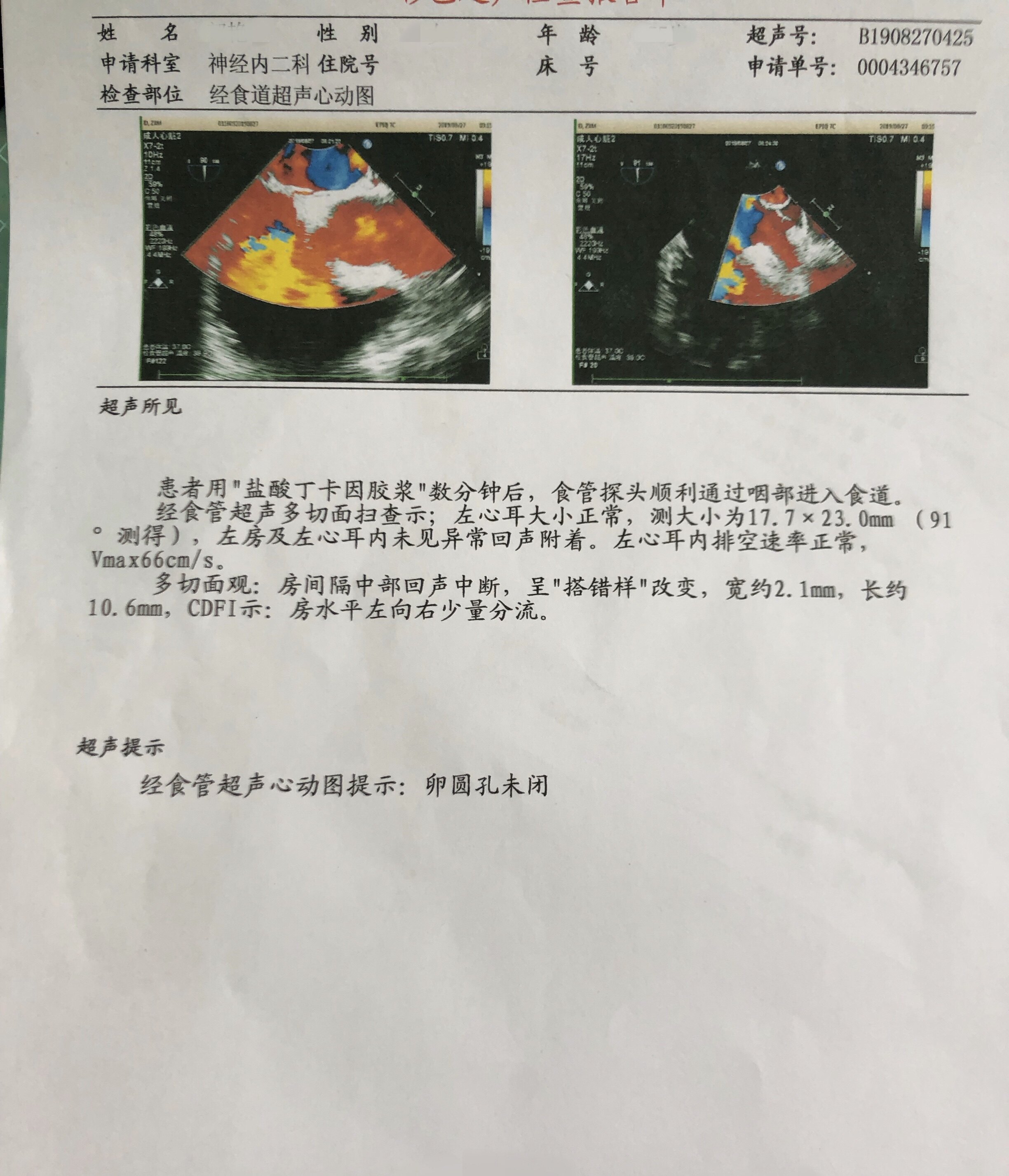 心脏病还能引起头痛心脏卵圆孔未闭pfo是偏头痛的原因之一