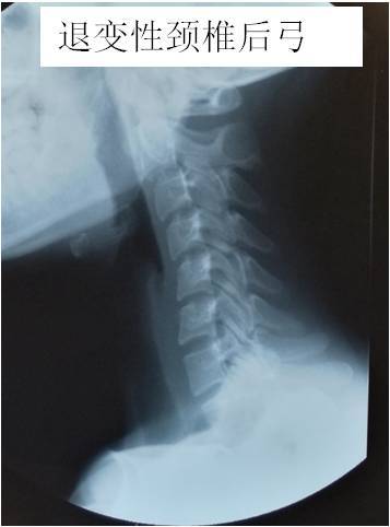 小科普 颈椎反弓 该怎么办 颈椎病 症状 治疗方法 检查 小科普 颈椎反弓 该怎么办 颈椎病 症状 治疗方法 检查