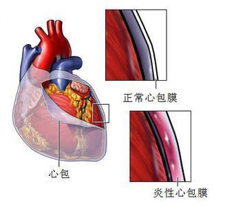 心包增厚图片