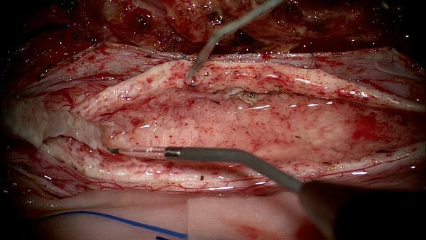 北京清华长庚医院脊柱脊髓精准微创培训班圆满举办