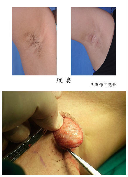 2,大汗腺切除术:通过手术方式将腋毛区的主要部分皮肤及皮下组织做