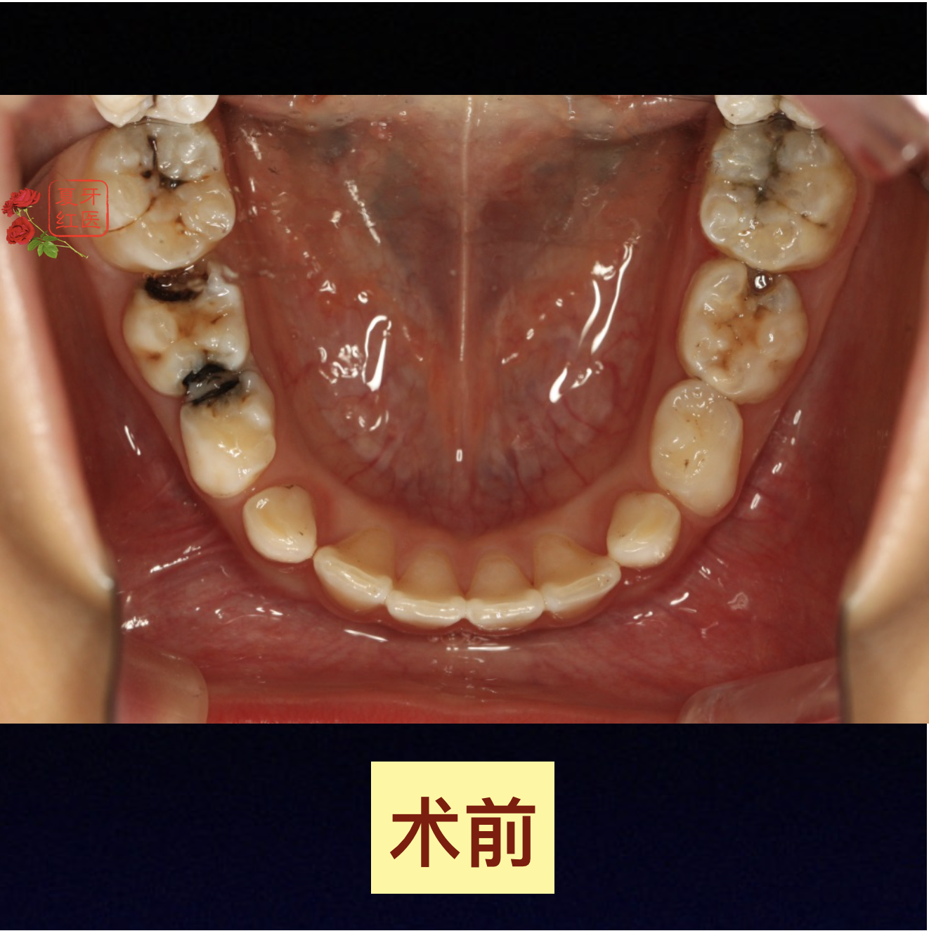 为了尽量保留活髓,局麻下牙钻与刮匙交替并用,慢而轻地去腐