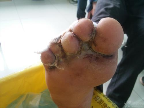 烂脚丫是怎么回事 脚气 脚气