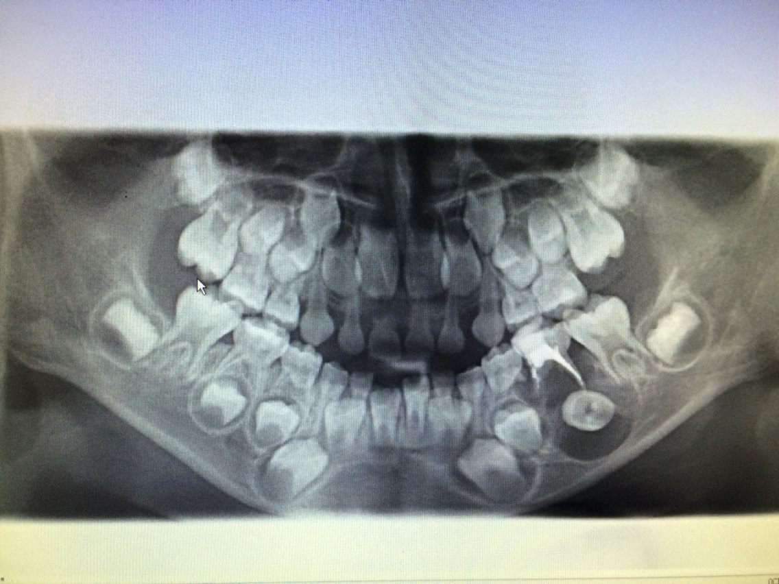 乳牙口腔全景片图片