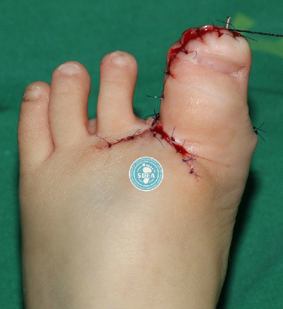 巨趾畸形的治疗 - 好大夫在线