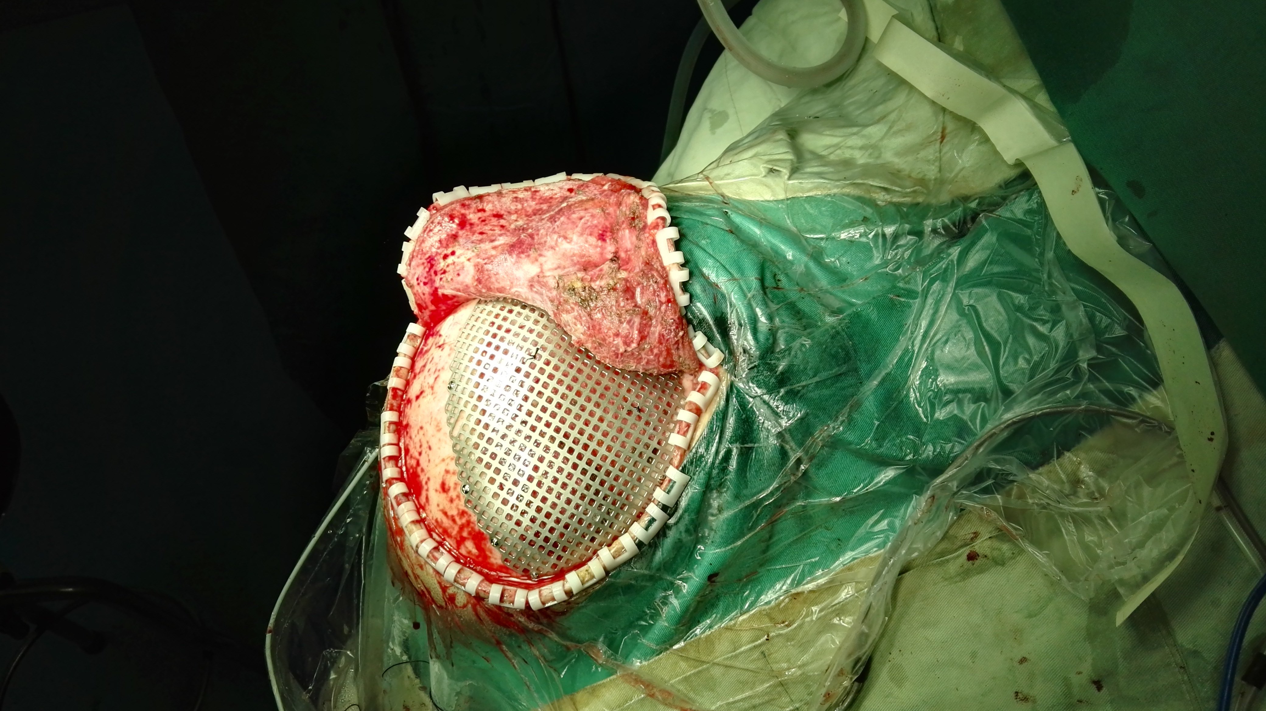 颅骨钛网手术图片