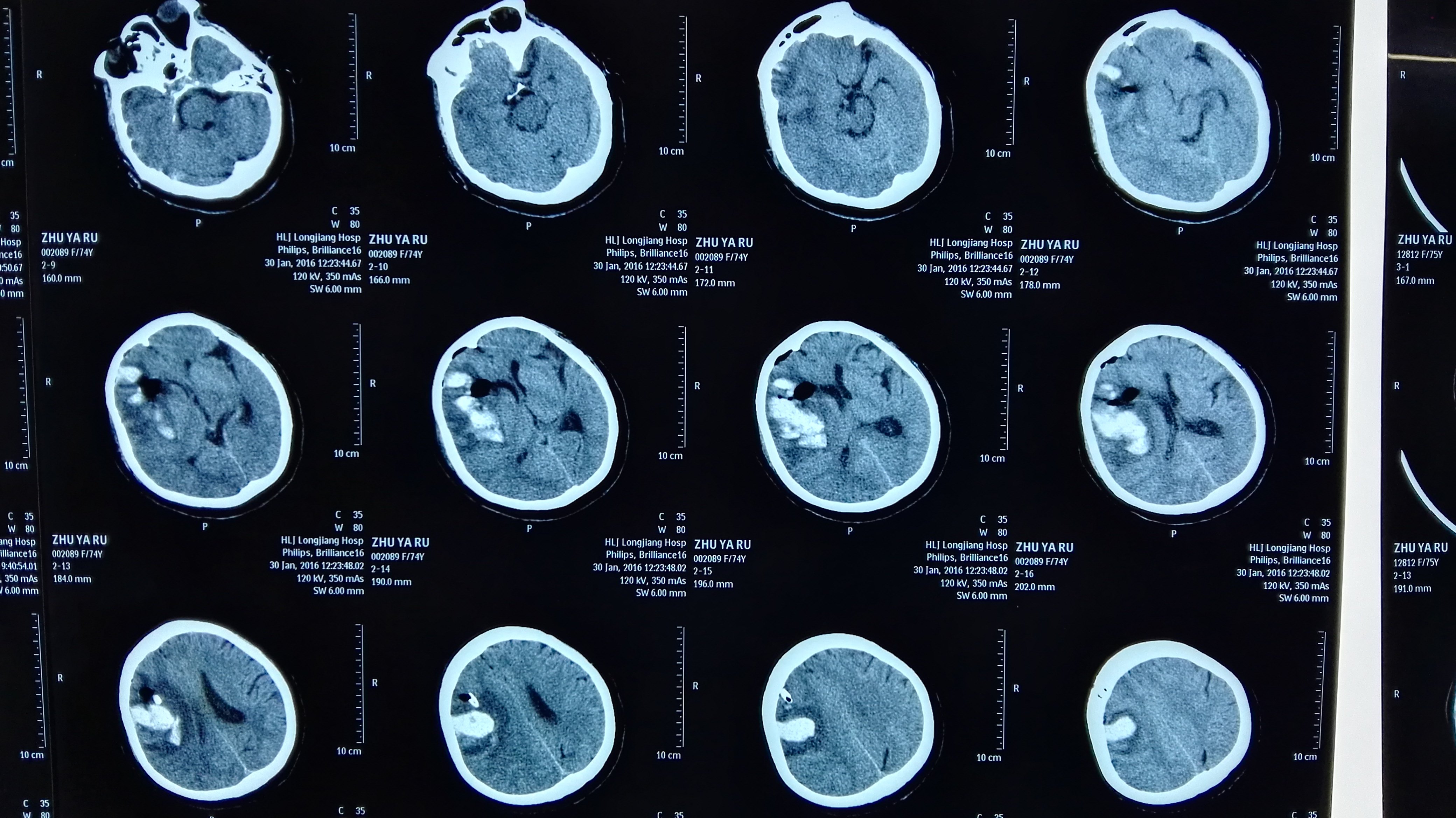 反复多部位脑出血脑淀粉样血管病