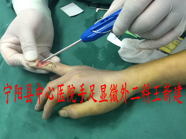 锤状指手术过程图片