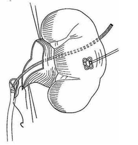肾积水插管手术图解图片