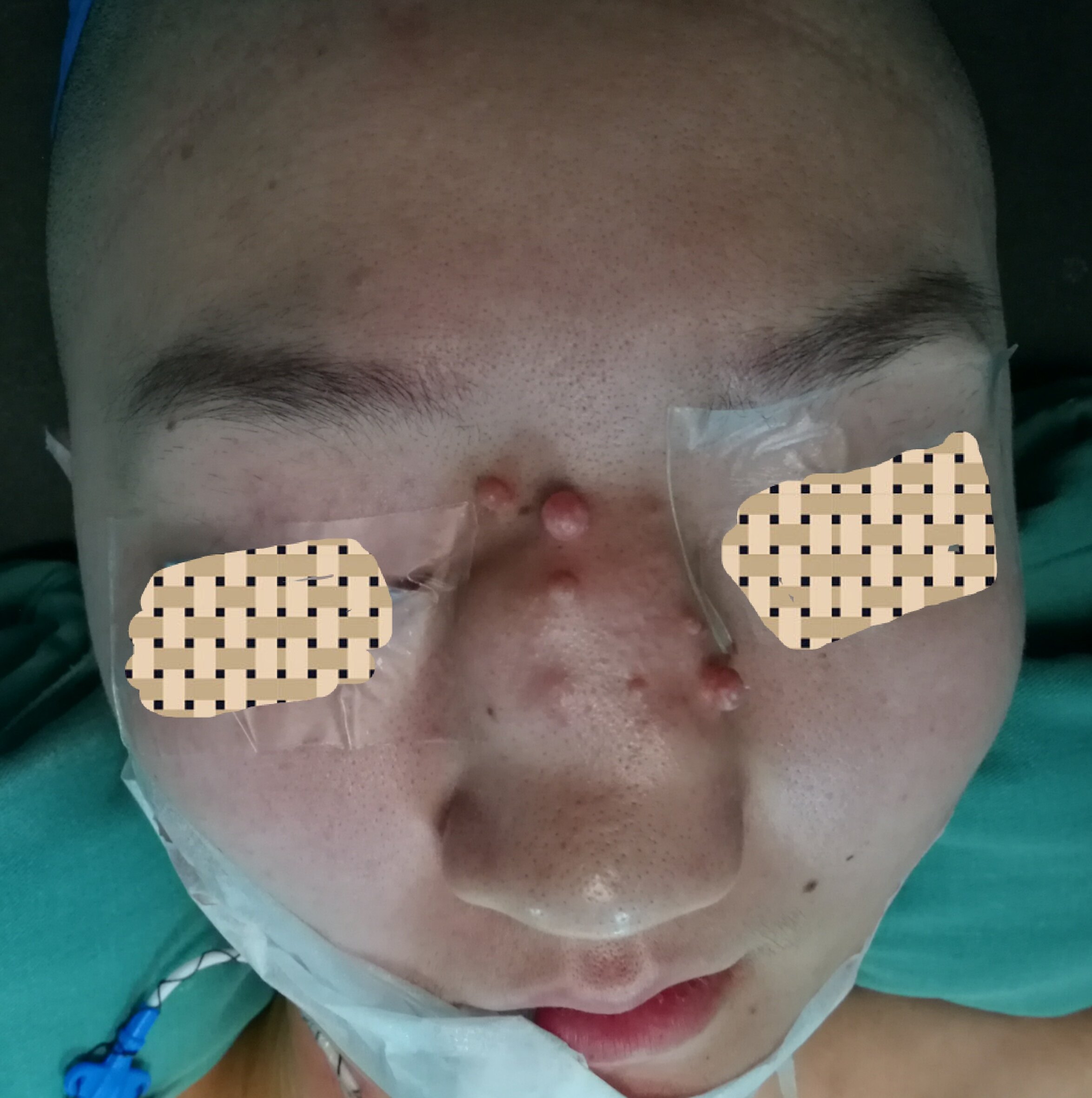 侵犯外鼻 鼻骨以及鼻内的巨大黏液表皮样癌的切除与修复重建 鼻肿瘤 手术 就诊指南 治疗方式 好大夫在线 侵犯外鼻 鼻骨以及鼻内的巨大黏液表皮样癌的切除与修复重建 鼻肿瘤 手术 就诊指南 治疗方式 好大夫在线