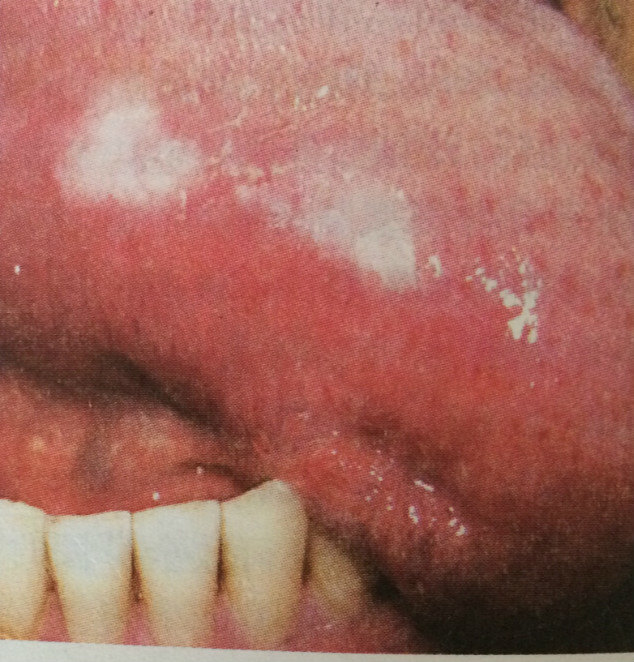 其实hiv急性期不会出现任何口腔症状.