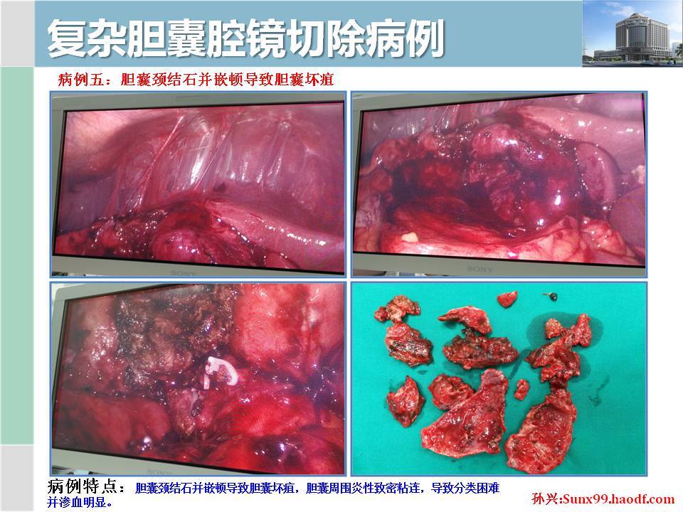 腹腔鏡膽囊切除術lc術者孫興