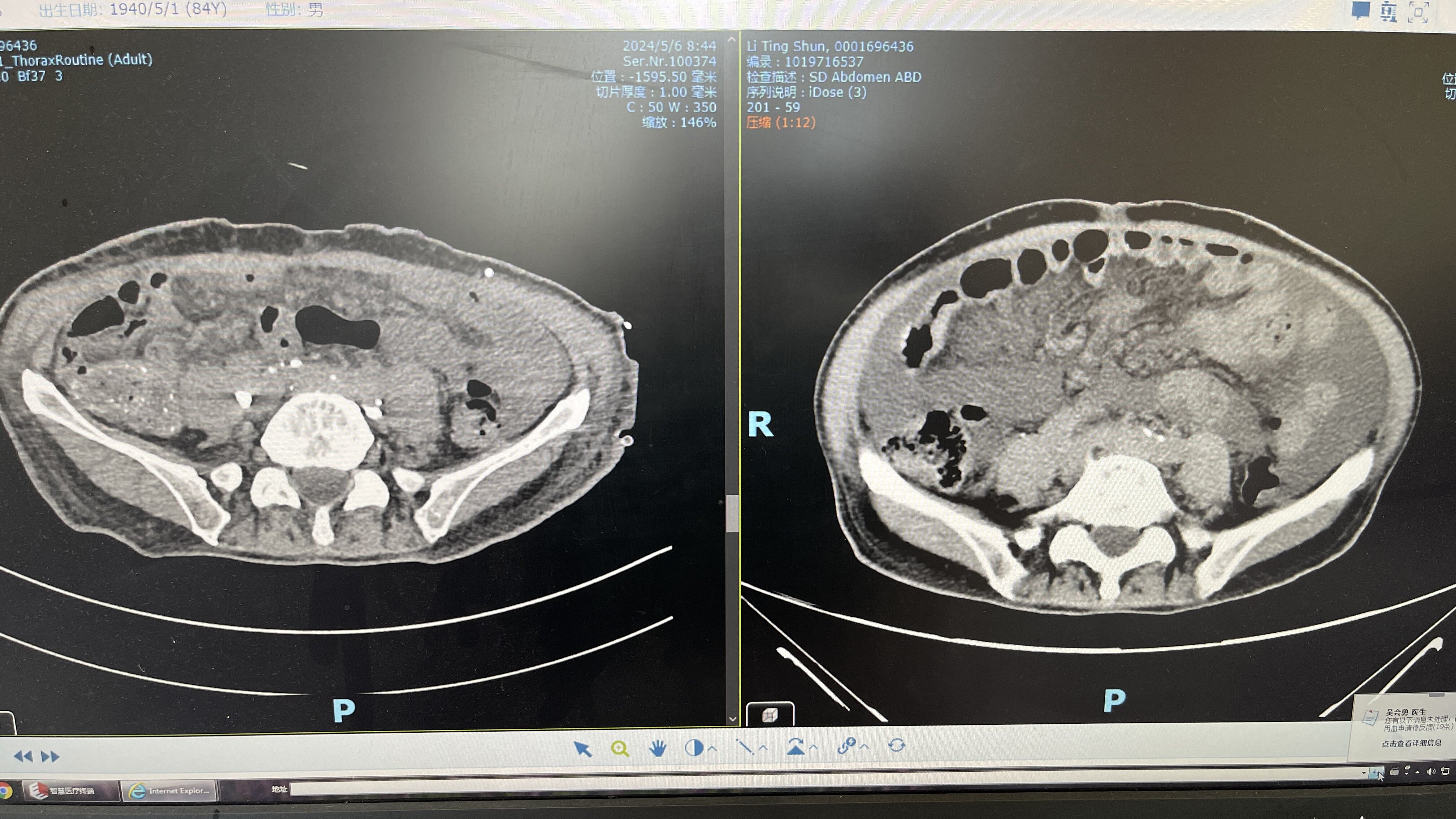 全身水肿伴乳糜腹又是胸导管阻塞惹的祸