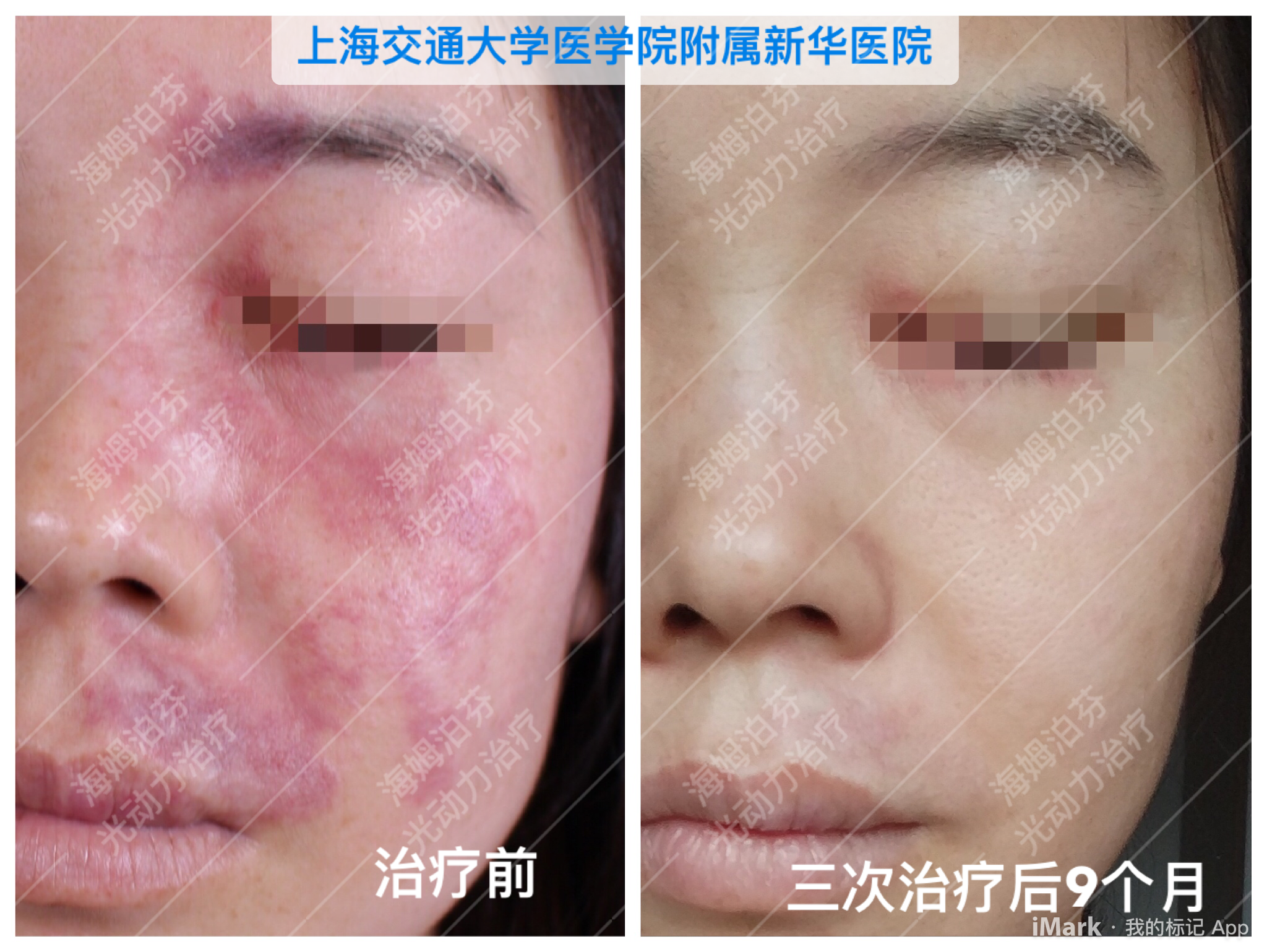 新华医院鲜红斑痣治疗(新药海姆泊芬光动力)_鲜红斑痣_鲜红斑痣治疗