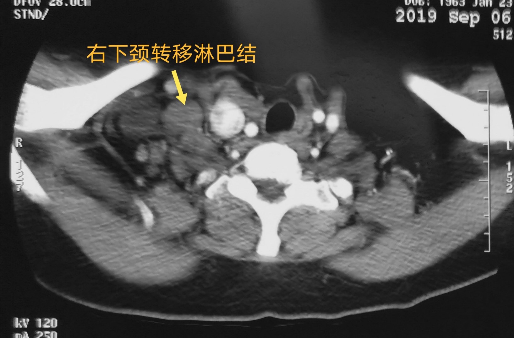 甲狀腺癌外院術後頸部及縱隔淋巴結轉移侵及右無名靜脈上腔靜脈瘤栓