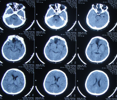 外出旅游遇车祸致重度颅脑外伤,6家医院经1年余4次脑室外引流术和2次