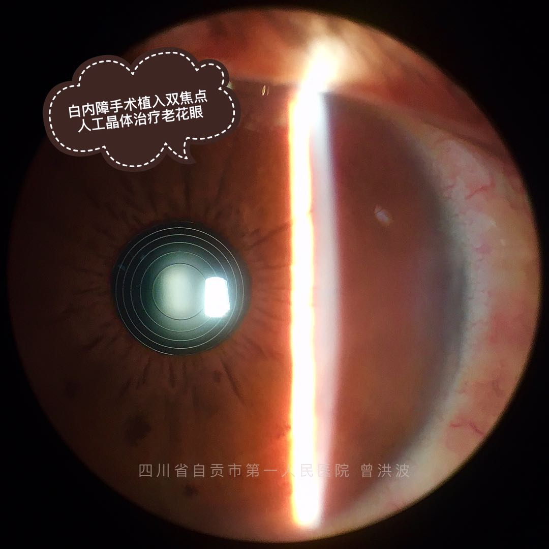 精美照片系列之三 多焦点人工晶体在眼睛里边的样子 白内障 好大夫在线 精美照片系列之三 多焦点人工晶体在眼睛里边的样子 白内障 好大夫在线