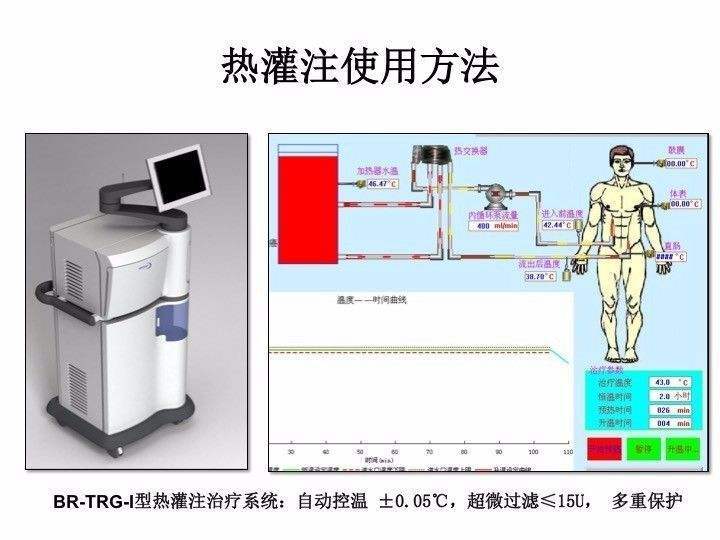 膀胱热灌注图片