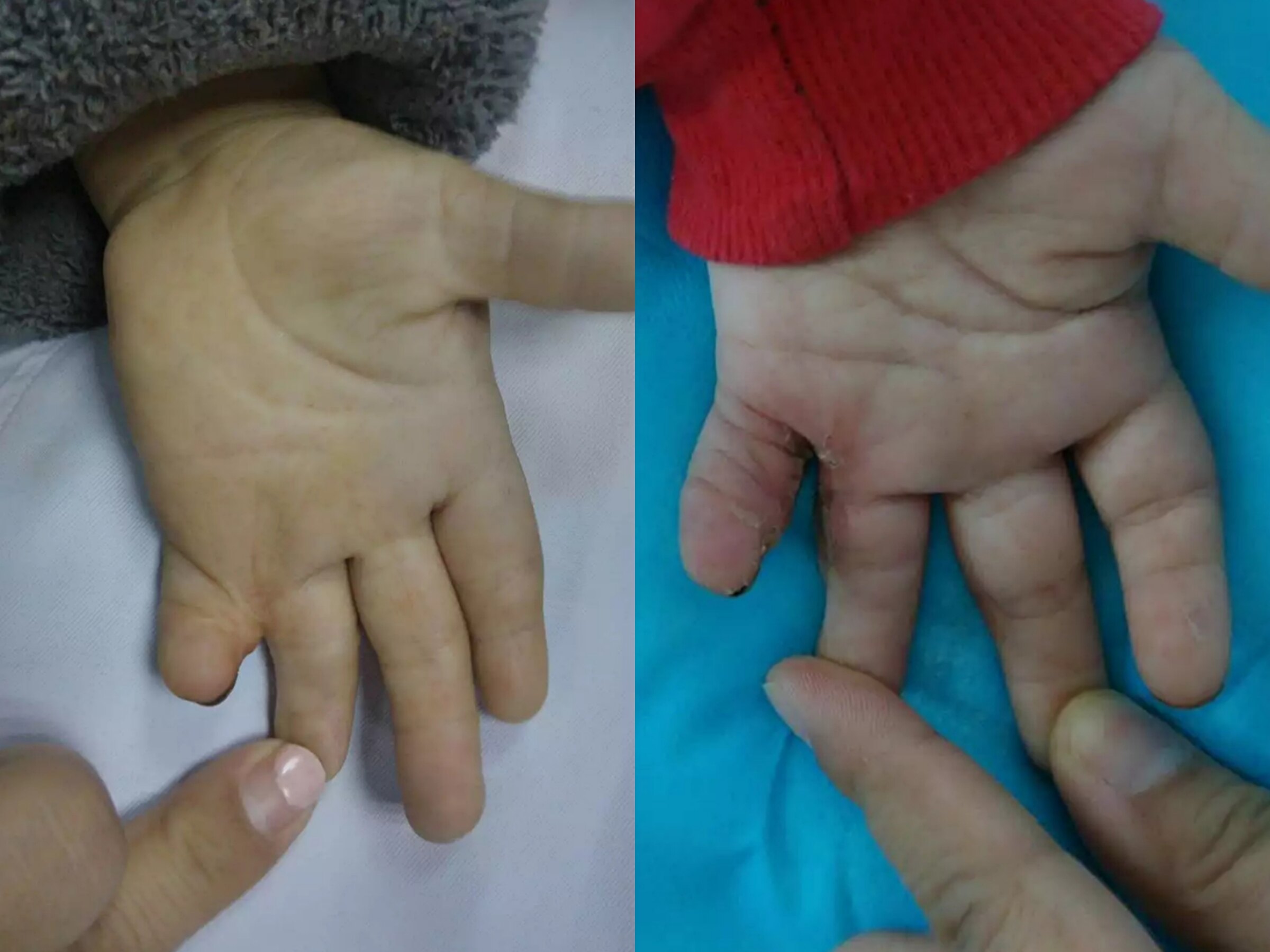 瘢痕治疗典型案例_疤痕_疤痕治疗方式 - 好大夫在线