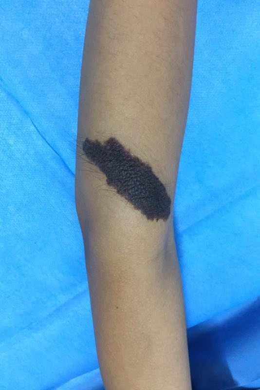 黑痣癌变图片_脚底黑痣癌变图片_黑痣会癌变吗