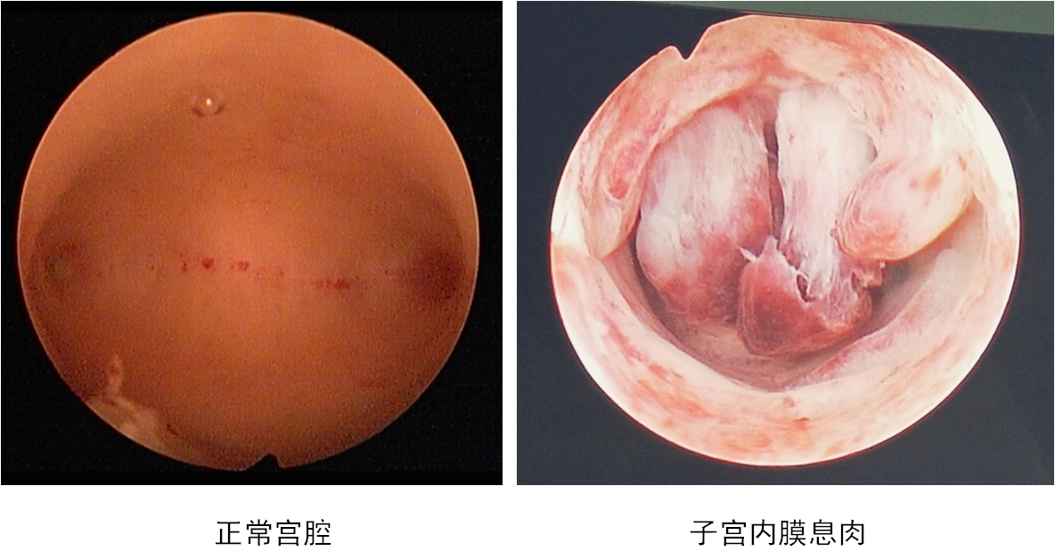 子宫内膜增生宫腔镜图片