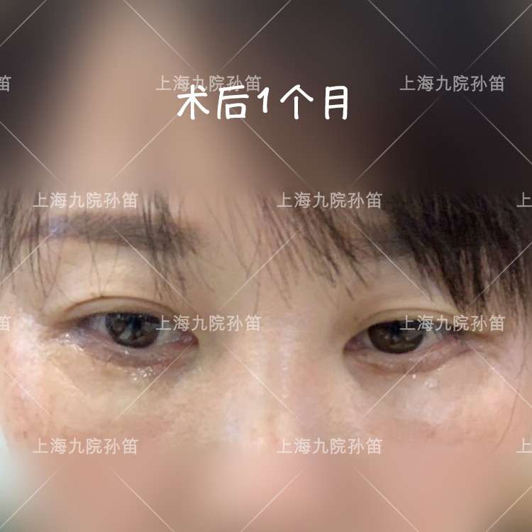 【孙笛个人案例】外切眼袋 眶隔释放,让眼部重新散发活力_去眼袋_去