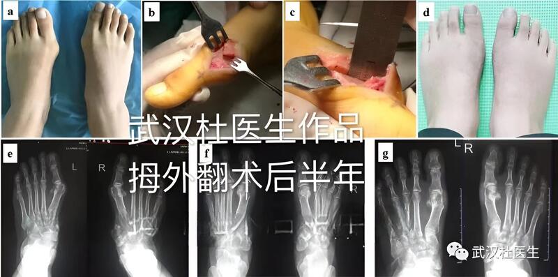 Austin截骨术治疗拇外翻手术照片