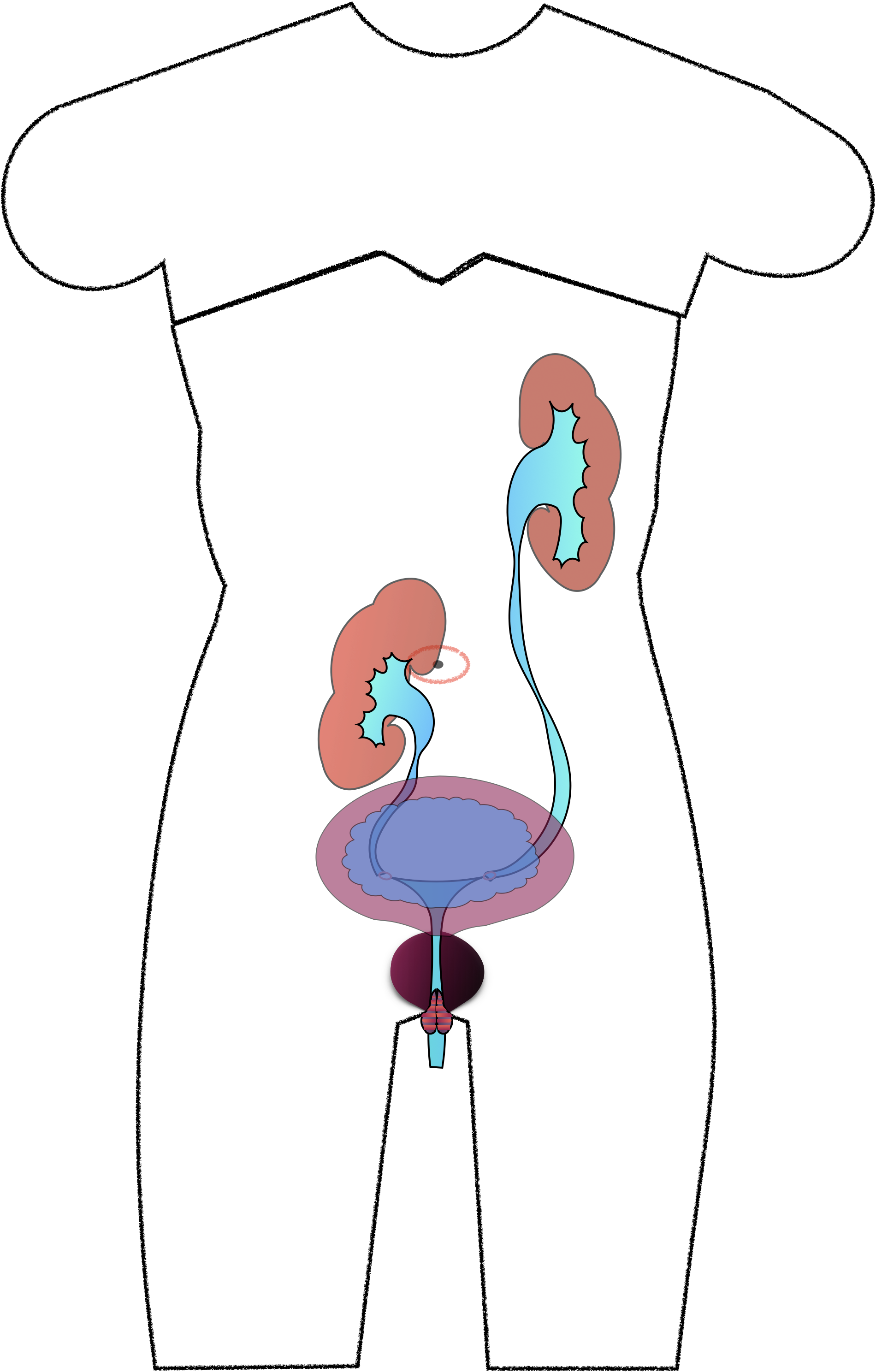 异位肾游走肾肾下垂肾脏跑了怎么回事