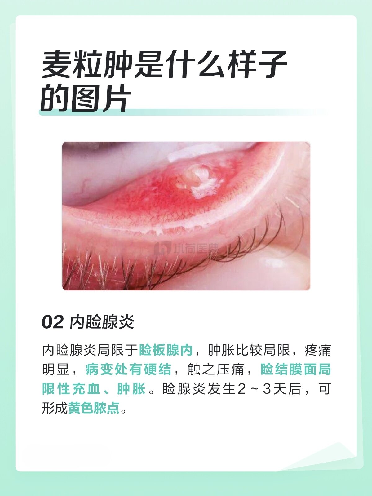 长了麦粒肿,怎样才能消得快?_麦粒肿_介绍_如何预防_治疗方式 - 好大夫在线